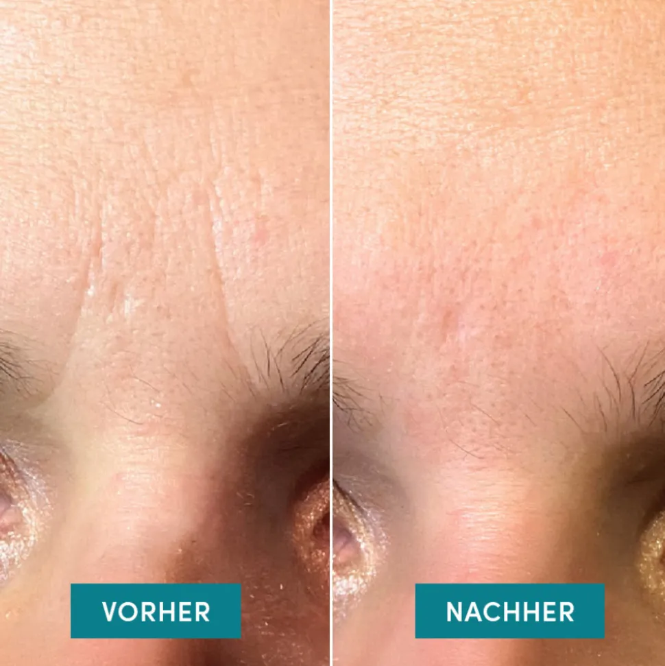 APRICOT Gesicht Patches mit Ectoin
