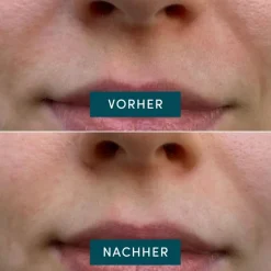 APRICOT Mini Mund Patches mit Niacinamide 24 Stück