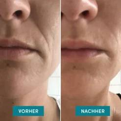 APRICOT Mund Patches mit Ectoin