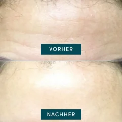 APRICOT Wiederverwendbares Stirn Pad mit Hexapeptid-Technologie