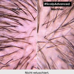 L'Oréal Professionnel Paris Série Expert Scalp Advanced Anti-Discomfort Intese Soother Treatment 200 ml