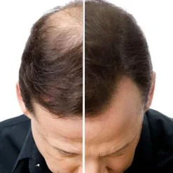 Natucain Hair Activator 100 ml